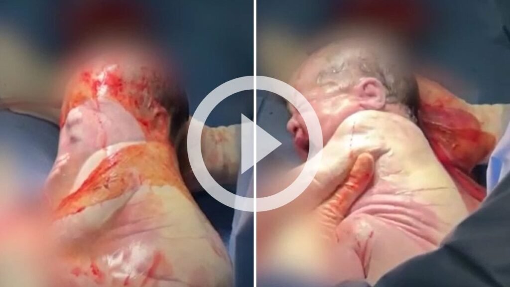 Parto Raro em SC: Um Evento Inusitado na Medicina